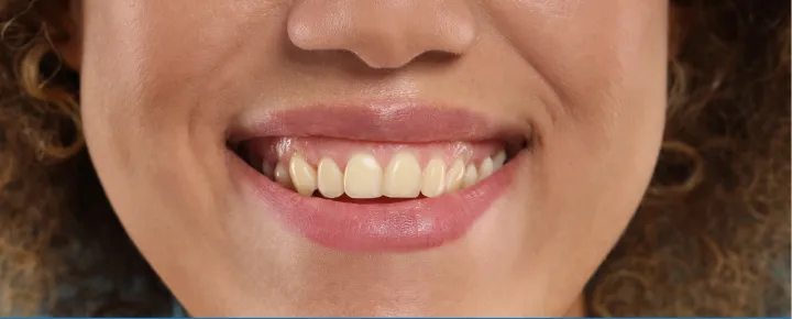 Before treatment